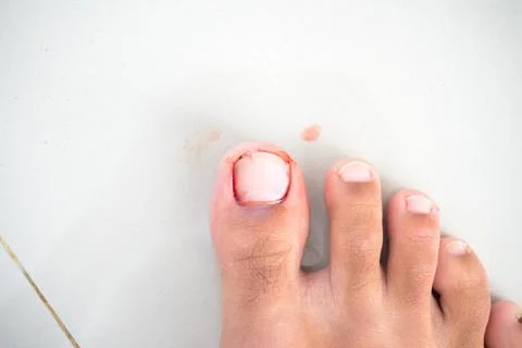 A big toe or big toe injury at the nail level. Isolated photo Stock-Fotos