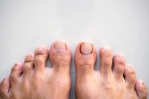A big toe or big toe injury at the nail level. Isolated photo Stock-Fotos