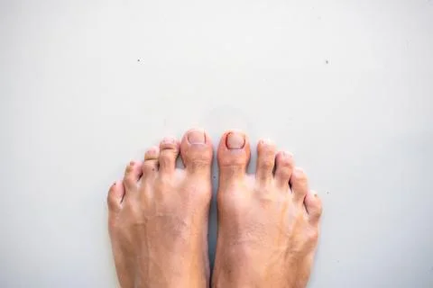 A big toe or big toe injury at the nail level. Isolated photo Foto stock