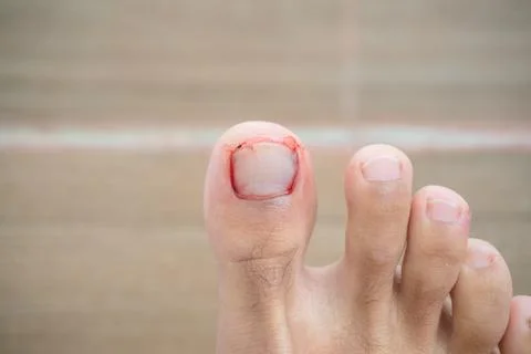 A big toe or big toe injury at the nail level. Isolated photo Foto stock