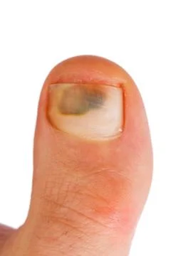 Big toe Foto stock