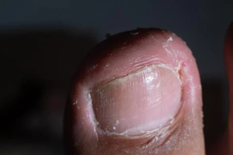 Big toe, whose toenail is infected with fungus and embedded within the skin Foto stock