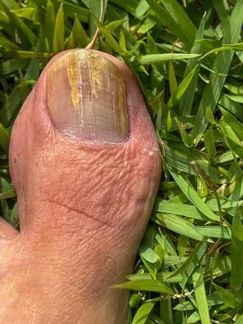 Big toenail with irregular appearance Stock Photos