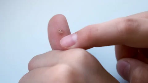 Big wart on human thumb finger before laser removing, closeup view. Stock Footage 159880804