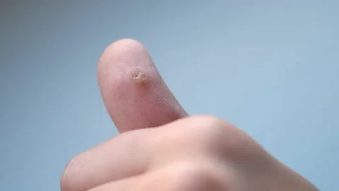 Big wart on human thumb finger before laser removing, closeup view. Stock Footage 168229914