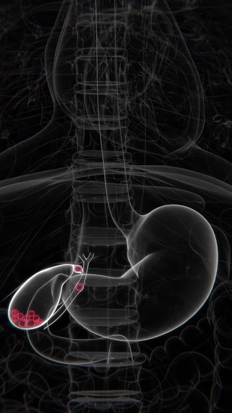 Bile Duct Obstruction Indication X-Ray Video | Bile Duct Obstruction in Stock Footage 301384003