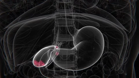 Bile Duct Obstruction Indication X-Ray HD Video | Bile Duct Obstruction in HD Stock Footage 328924832