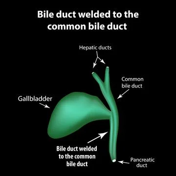 Bile duct welded to the common bile duct. Pathology of the gallbladder Stock Illustration