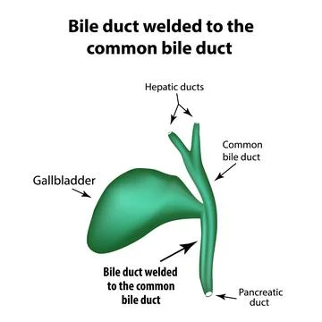 Bile duct welded to the common bile duct. Pathology of the gallbladder Stock Illustration