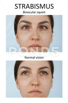 Binocular squint. Strabismus Stock Photos