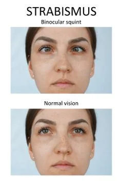 Binocular squint. Strabismus Foto stock