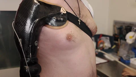Bionic technology, Prosthetic wear, Robotic arm 库存影片 340156888