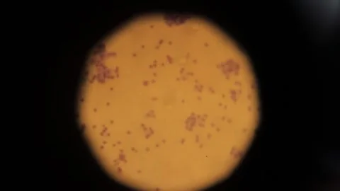 Biopsy. biopsy results under a microscope. Anatomical theme. Stock Footage 258062319