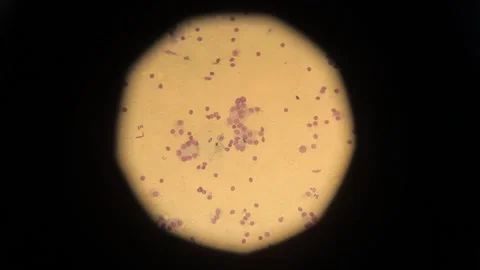 Biopsy. biopsy results under a microscope. Anatomical theme. Stock Footage 270180731
