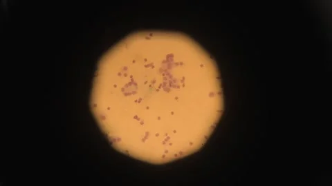 Biopsy. biopsy results under a microscope. Anatomical theme. Stock Footage 270180744