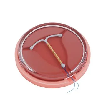 Birth Control Concept. T Shape IUD Copper Intrauterine Device in Plastic Pa.. Illustrazione stock