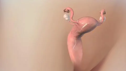 Birth control device (IUD) Stockillustratie