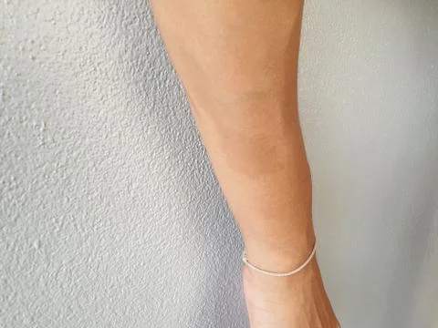 Birthmark on arm surface. Almost harmonious and invisible Stock Photos