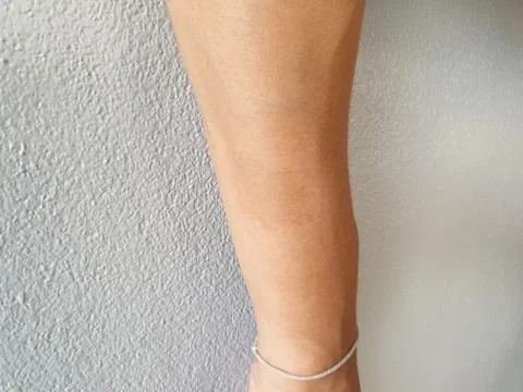 Birthmark on arm surface. Almost harmonious and invisible Stock Photos