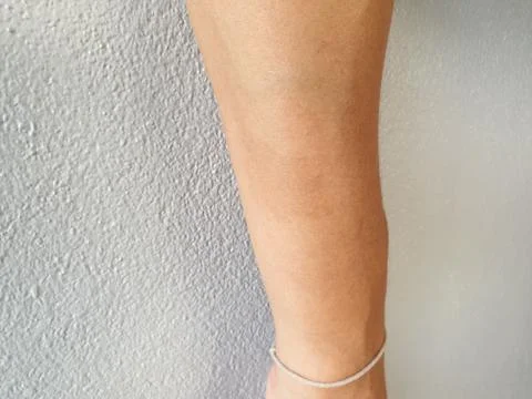 Birthmark on arm surface. Almost harmonious and invisible Stock Photos