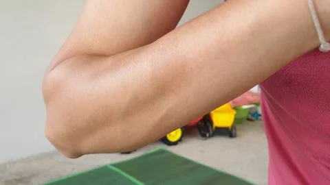 Birthmark on arm surface. Almost harmonious and invisible Stock Photos