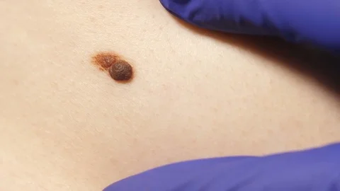 Birthmark on the body Stock Footage 78051322