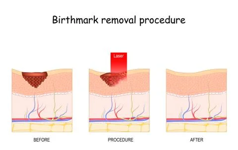 Birthmark laser Removal Stock Illustration