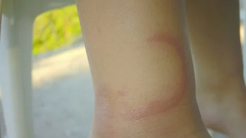Bite of jellyfish on leg Stock Footage 81762275