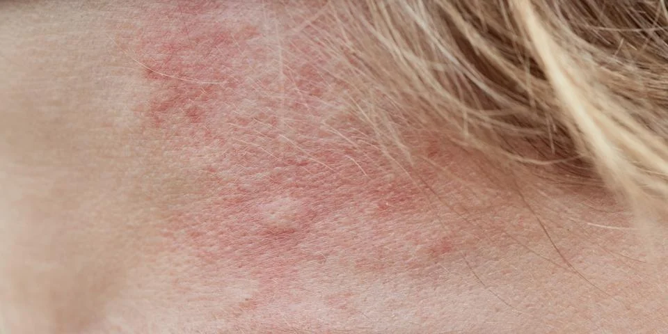 Bite mark, sting or sore on human skin. Close up of symptoms. Healthcare theme. Stock Photos