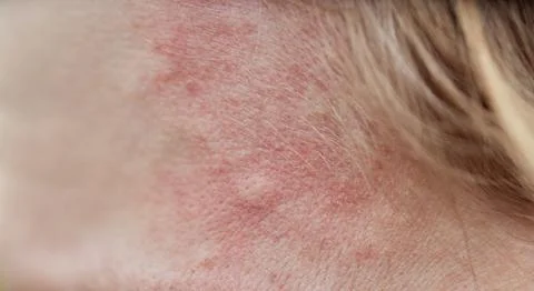 Bite mark, sting or sore on human skin. Close up of symptoms. Healthcare theme. Foto stock