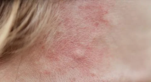 Bite mark, sting or sore on human skin. Close up of symptoms. Healthcare them Stock Photos