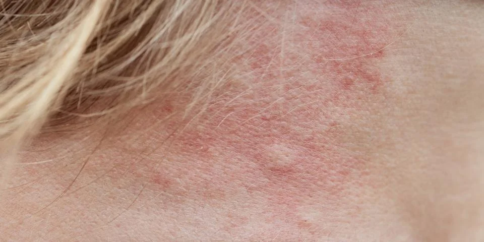 Bite mark, sting or sore on human skin. Close up of symptoms. Healthcare them Stock Photos