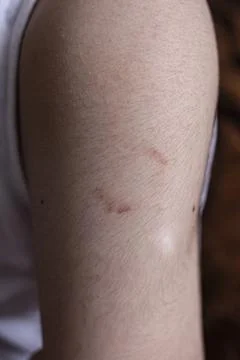 Bite marks pattern bruise on a young boys arm, bullying aggressive behavior.. Foto stock