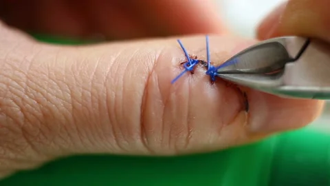 Bite through the surgical suture line. Finger wound close-up, contains people, r Stock Footage 143749377