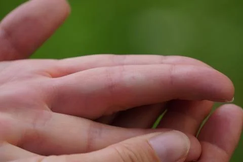 The bite of a wasp or bee on the finger, the place of the bite is white and s Stock Photos