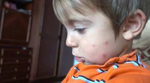 Bite wounds on cheek of child Stock Footage 64043763