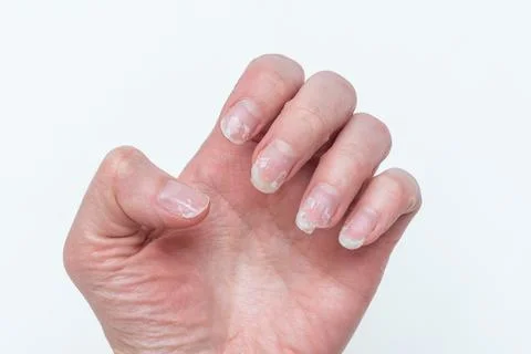 Bitten and broken nails without manicure with an overgrown cuticle of the nai Stock Photos