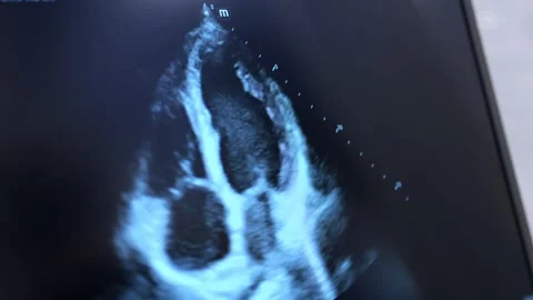 A black and blue image of a woman's breast Stock Footage 297650353