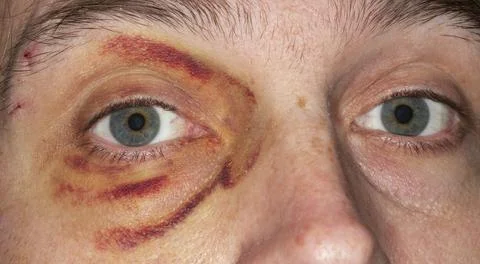 Black eye Stock Photos