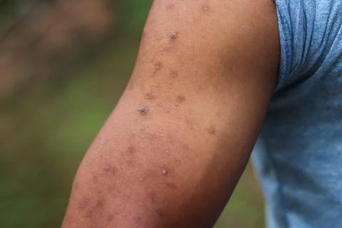 Black marks on human hand Stock Photos