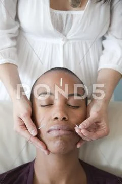 Black Woman Receiving Acupuncture Treatments