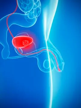 Bladder cancer, artwork Stock Illustration