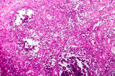 Bladder cancer, light micrograph Stock Photos