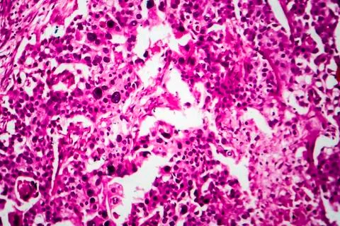 Bladder cancer, light micrograph Stock Photos