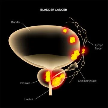 Bladder cancer stages Stock Illustration