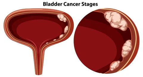 Bladder Cancer Stages Vector Stock Illustration