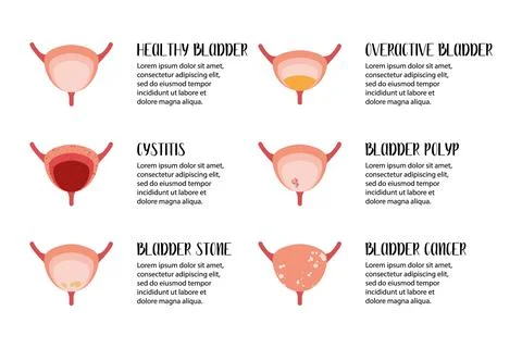 Bladder diseases. Cystitis, overactive bladder, stones, cancer, polyp. Urolog Stock Illustration