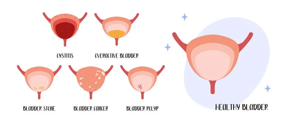 Bladder diseases. Cystitis, overactive bladder, stones, cancer, polyp. Urolog Illustrazione stock