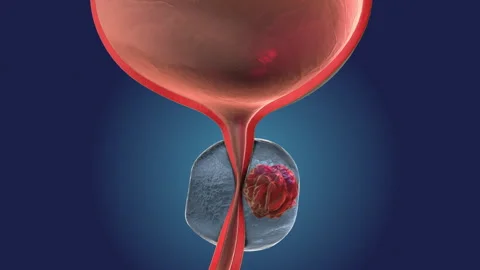 Bladder Function Impacted by Prostate Gland Cancer Stock Footage 307283980