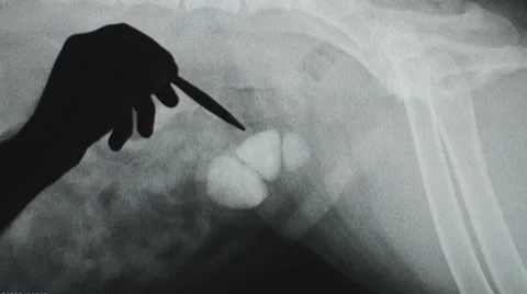 Bladder Stone Radiograph Vídeos de archivo 39885131